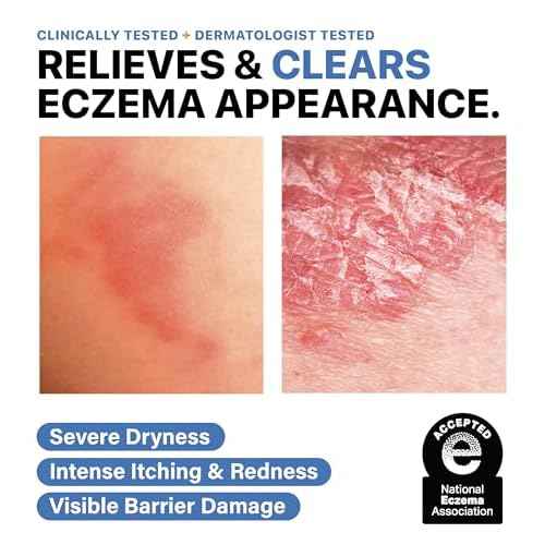 Eczema Cream for Adults & Kids ? Hypoallergenic Barrier Repair Moisturizer, Clinically Proven (3 Studies), Fragrance-Free, Dermatologist Tested, Face & Body Hydration, NEA Accepted, USA Made