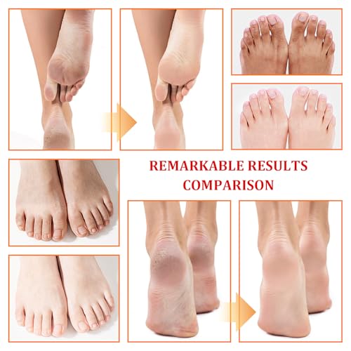 Orange Oil Exfoliating Foot Peeling Spray - Dead Skin & Callus Remover