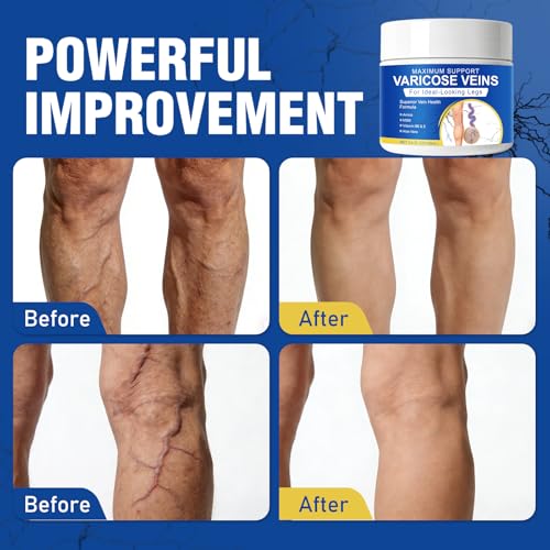 Varicose Veins Cream for Legs - Spider Veins Treatment, 3.4 Oz