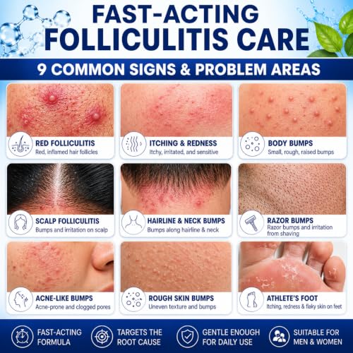 5% Benzoyl Peroxide Folliculitis Treatment Cream - 3.53 oz