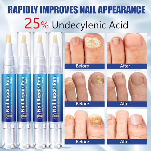 Toenail Fungus Treatment Pen - 25% Undecylenic Acid