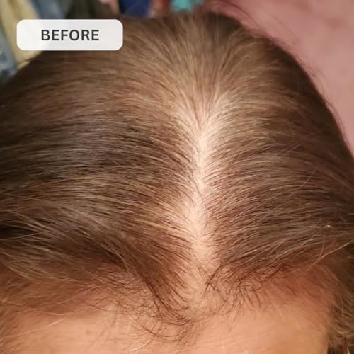 Kiierr 272 MD Laser Cap | FDA-Cleared Hair Loss Treatment