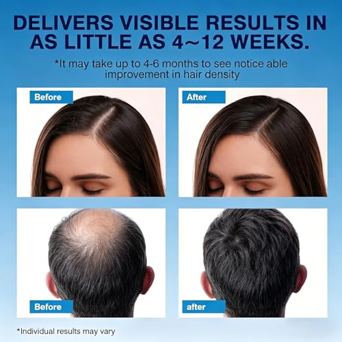 Minoxidil Hair Regrowth Foam for Men - Thinning Hair & Beard Treatment, 2x2.11 Oz