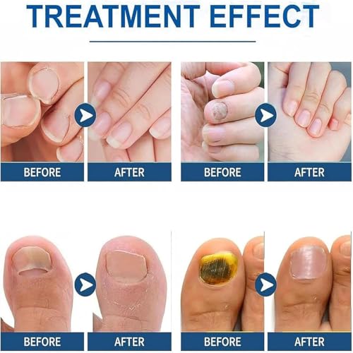 Nail Fungus Treatment Pen - Extra Strength Toenail Repair, 4 Pack