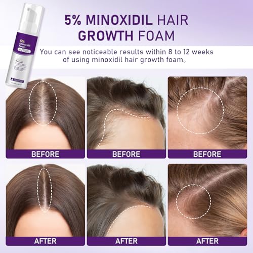 5% Minoxidil Foam for Women - Hair Growth & Thinning Solution