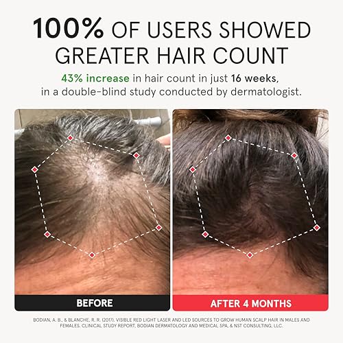 iRestore Elite Laser Hair Growth Cap - 500 Lasers & LEDs