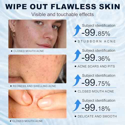 Azelaic Acid 10% Cream for Face - Acne Cream for Rosacea Reducing Relief Pimple Breakouts Blackhead Pigmentation and Redness - Azelaic Acid Gel For Facial and Skin Care