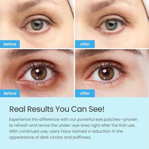 PLANTIFIQUE Superfood Under Eye Patches ? 12 Pairs with Hyaluronic Acid for Dark Circles & Puffy Eyes ? Anti-Aging Skincare Gel Mask, Gift for Women & Men