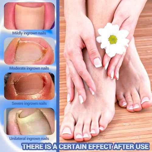 Ingrown Toenail Treatment, 80 Pcs Glue-Free Breathable Corrector Patches, Professional Ingrown Toenail Tools, Not Prone to Falling Off, with File (2 Fl Oz (Pack of 1))