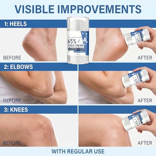 Grospe 65% Urea Foot Cream Stick with Salicylic Acid, 1.58 Oz