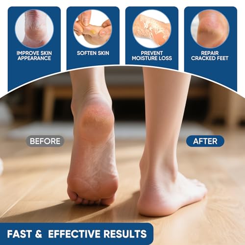 VREKEF 40% Urea Cream with 2% Salicylic Acid for Dry Cracked Heels (5.29 oz)