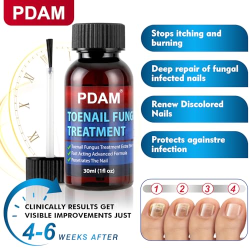 Toenail Fungus Treatment - 25% Undecylenic Acid Maximum Strength
