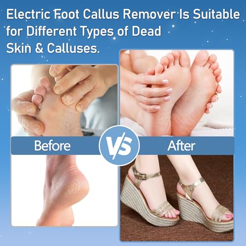 Electric Callus Remover Kit for Feet - 2 Speed Waterproof File
