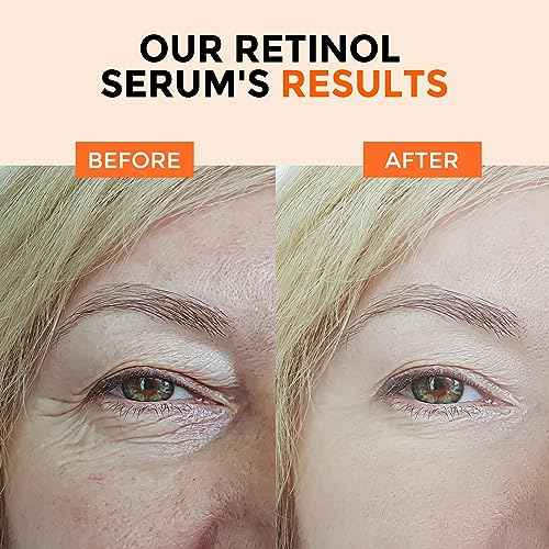 Retinol Serum for Face 2.5%, B5 Resurfacing Retinol Serum with Vitamin C, Vitamin E, Hyaluronic Acid, Niacinamide, Peptide for Anti-Aging, Wrinkle Smoothing, Dark Spot Corrector, Brighten Dullness