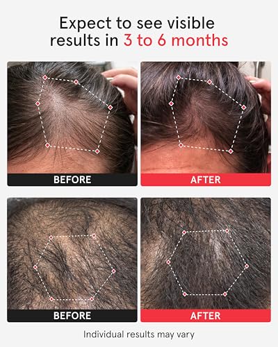 iRestore Pro Laser Hair Growth System - 282 Lasers