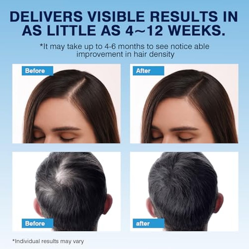 5% Minoxidil Foam Hair Regrowth Treatment for Men & Women
