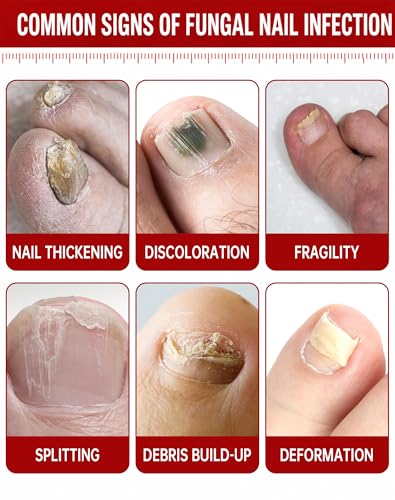 Toenail Fungus Treatment - 1% Tolnaftate & Triple Acid Complex
