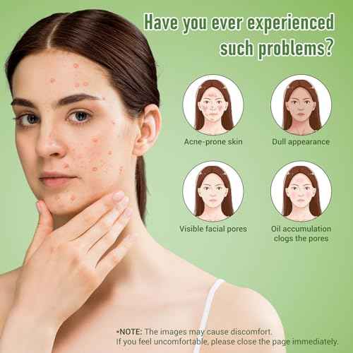 14% Azelaic Acid Acne Cream, Azelaic Acid For Face, Helps Improve the Appearance of Acnes - Azalecic Acids Acido Azelaico, 1 Fl Oz