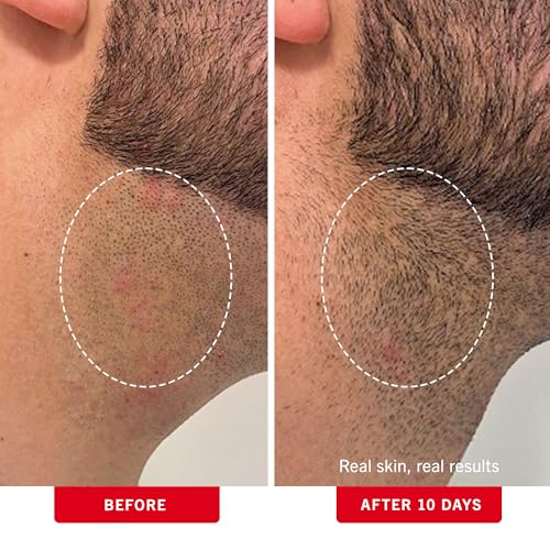 First Aid Beauty - Ingrown Hair Pads with BHA + AHA - Aftershave Treatment Pads to Help Prevent Razor Bumps for Men & Women - Exfoliate Underarms & Bikini Area - Compostable for Daily Use - 60 Pads