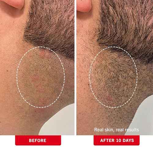 First Aid Beauty - Ingrown Hair Pads with BHA + AHA - Aftershave Treatment Pads to Help Prevent Razor Bumps for Men & Women - Exfoliate Underarms & Bikini Area - Compostable for Daily Use - 28 Pads