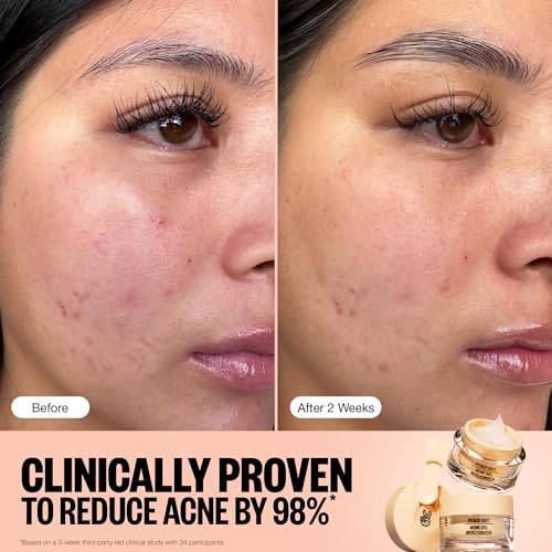 PEACE OUT Acne Gel Moisturizer for Oily Skin, Face Cream for Acne-Prone Skin with 2% Salicylic Acid, Niacinamide and Ceramides, 1.69 fl oz