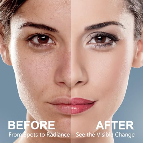 Dark Spot Corrector & Remover for Face & Body ? Gentle Formula for Dark Spots, Uneven Skin Tone, Age Spots & Melasma ? with Niacinamide, Hydrolyzed Collagen & Hyaluronic Acid ? 1.06 FL OZ