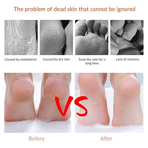 Professional Pedicure Callus Shaver Set with 10 Blades & Case