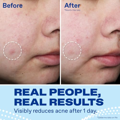 Differin 10% Benzoyl Peroxide Acne Spot Treatment, 1 oz