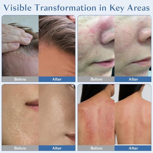 Seborrheic Dermatitis Cream for Face & Scalp - Nourishing Moisturizer with Azelaic Acid & Niacinamide
