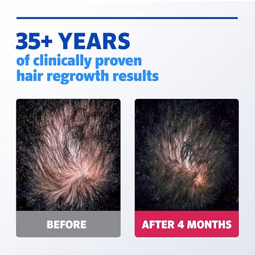 Men's Rogaine Extra Strength 5% Minoxidil Topical Solution for Hair Loss & Regrowth, Topical Treatment for Men, Unscented Minoxidil Follicle Booster Liquid, 1-Month Supply, 2 fl. oz
