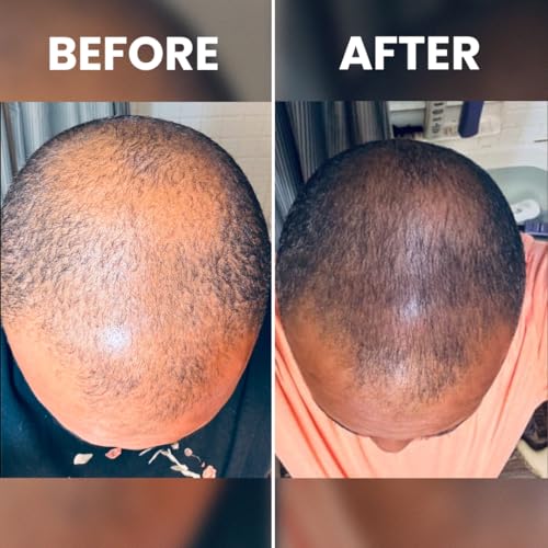 Rennora Hair Growth Serum 1 Fl Oz (Pack of 2) - Peppermint, Nettle & Rosemary Oil for Black Hair Growth