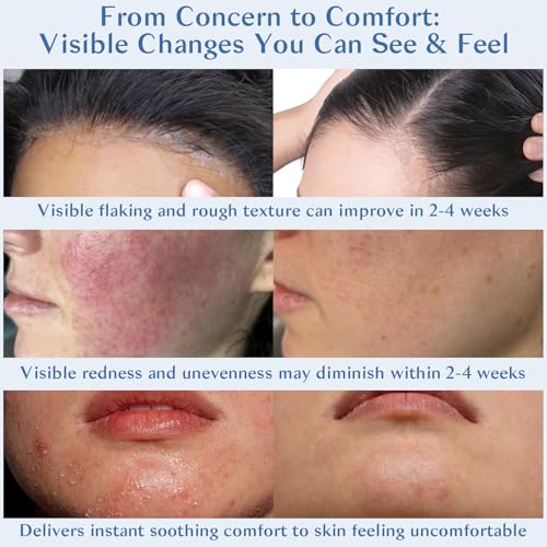 Seborrheic Dermatitis Cream for Face & Scalp - Nourishing Moisturizer with Azelaic Acid & Niacinamide