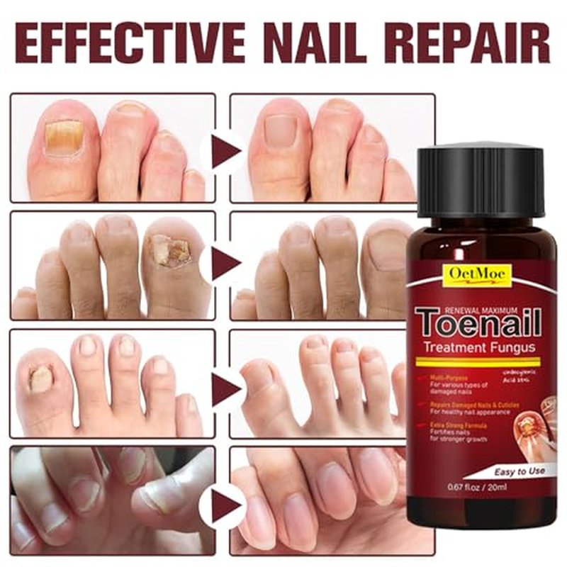Extra Strength Toenail Fungus Treatment with 25% Undecylenic Acid