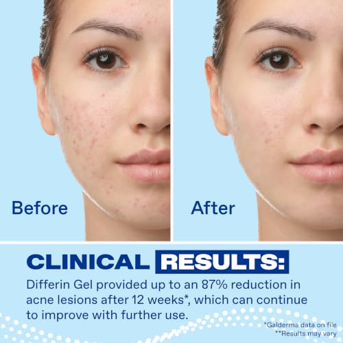 Differin Acne Retinoid Treatment Gel, 0.1% Adapalene, 45g Pump