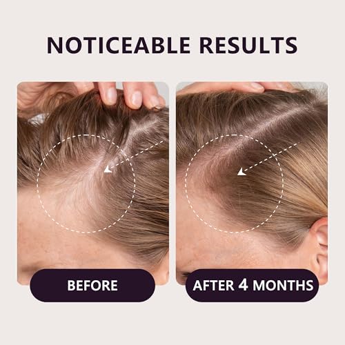5% Minoxidil Hair Growth Serum for Women - Extra Strength Treatment