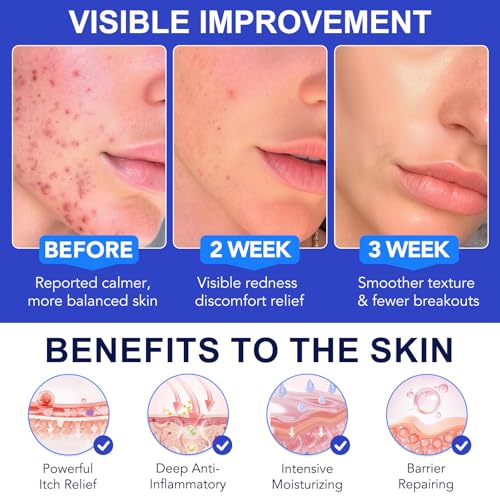 Salicylic Acid Acne & Folliculitis Cream 100g