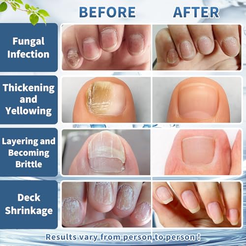 Maximum Strength Nail Fungi Treatment - Fast Acting Liquid Drops