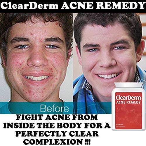 Clearderm Acne Tablets - Daily Spot Treatment