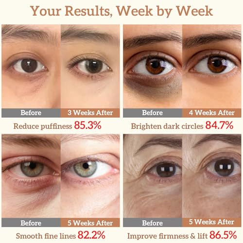 Anti-Aging Caffeine Eye Cream and Serum Set for Dark Circles, Puffiness and Fine Lines - Firming Under Eye Treatment with Niacinamide and Hyaluronic Acid for Brightening and Hydrating Sensitive Skin