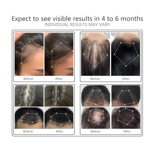 Laser Hair Growth Comb | FDA Cleared LLLT Device for Hair Loss