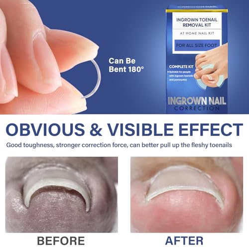 Ingrown Toenail Treatment-Patch(10pcs), Ingrown Toenail Corrector(Titanium Alloy), Ingrown Toenail Removal Kit, Cuttable Applicable for Any Nail Size, Nail Repair for Finger and Foot, Reusable