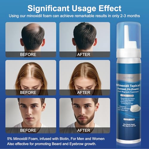 5% Minoxidil Foam with Biotin – Hair Growth Treatment for Men & Women