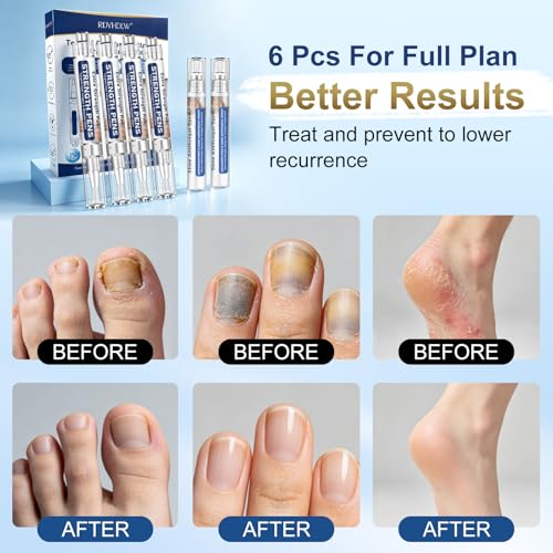 Toenail Fungus Treatment Pen Kit with Sanitizer - 25% Undecylenic Acid
