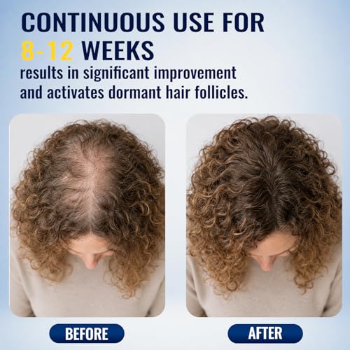 5% Minoxidil Foam for Thinning Hair Care - 2 Pack, 80ml Each