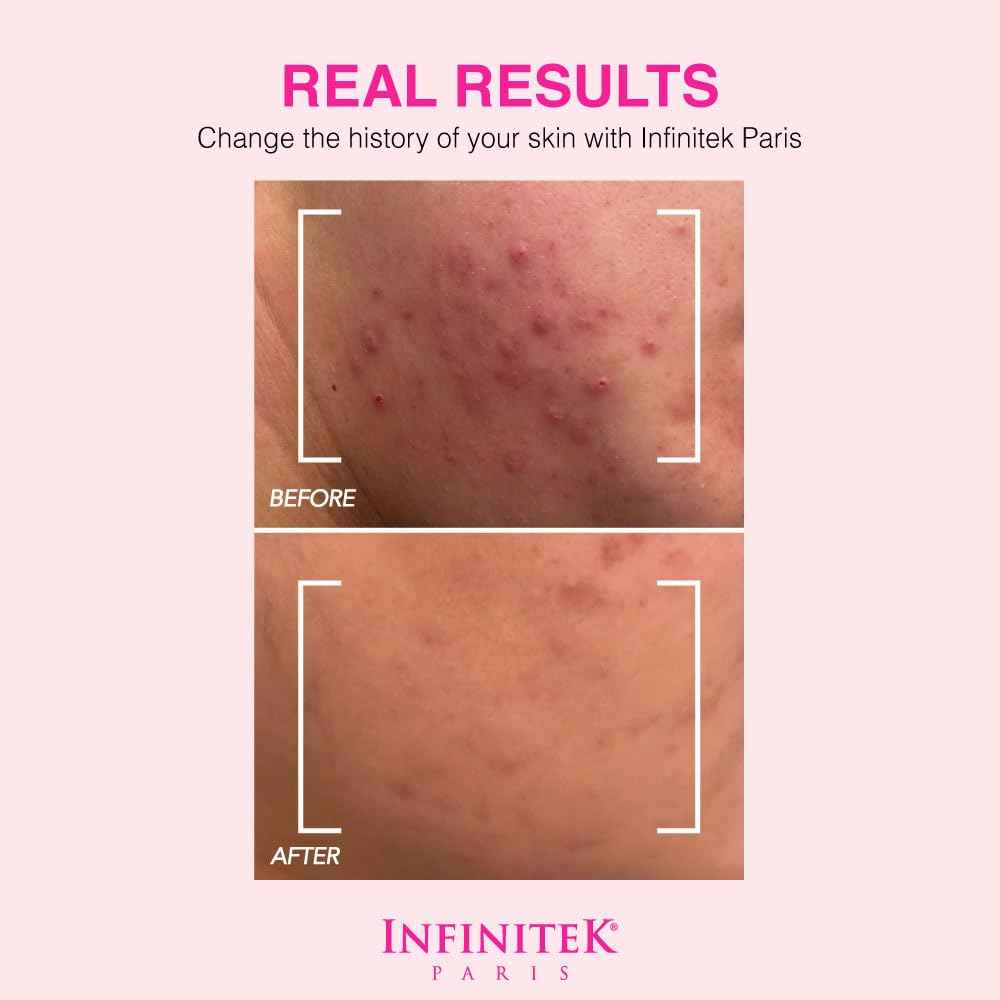 Infinitek Paris Dead Sea Mud Mask 6.34 Fl Oz - Face Mask for Acne Treatment, Blackhead Remover, Antioxidant Pore Cleaner