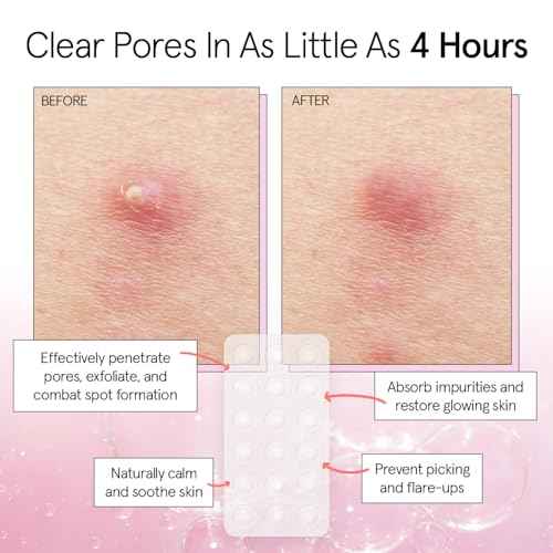 grace & stella Award Winning Pimple Patches for Face - Dermatologist Tested Acne Patches - Hydrocolloid Patch for Breakouts, Whiteheads - Vegan Acne Spot Treatment for Face (Invisible, 216 Count)
