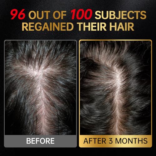 Minoxidil 5% Hair Regrowth Serum for Men & Women, 60ml