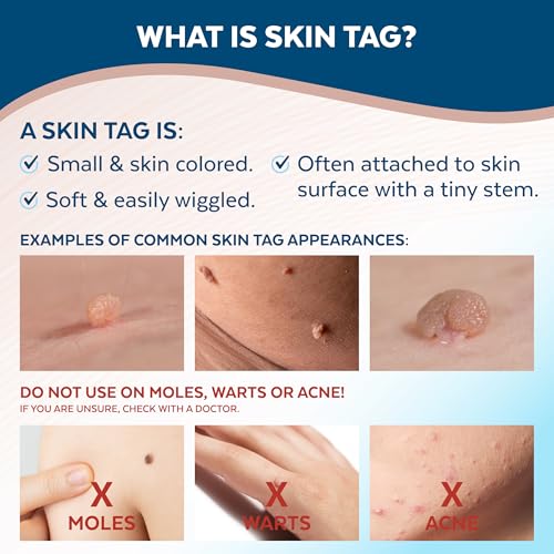 Claritag Advanced Skin Tag Remover - FDA-Cleared Cryogenic Kit