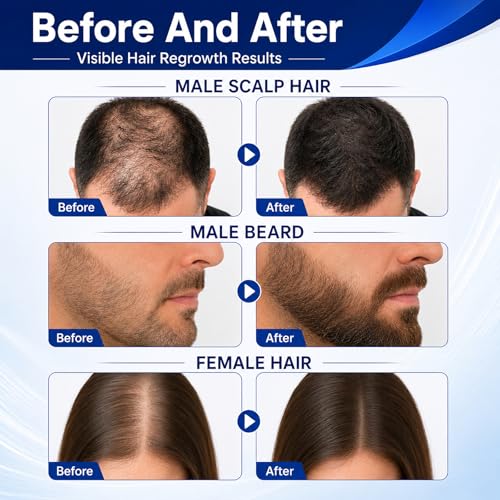 5% Minoxidil Hair Growth Spray for Men & Women - 3 Bottle Set