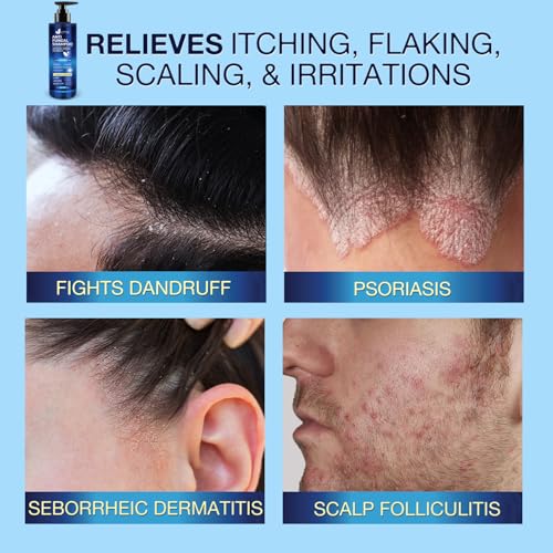 Uttse Anti-Fungal Scalp Shampoo for Psoriasis & Dandruff Relief - 300mL